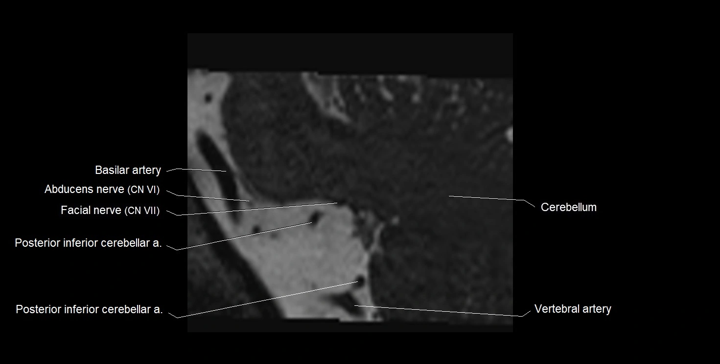 Internal auditory meatus (IAM) 3T sagittal cross sectional anatomy image 48.webp